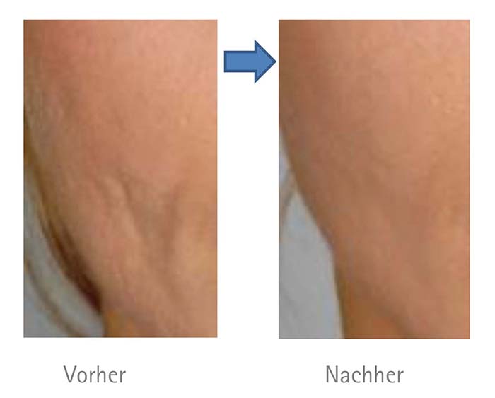 Vorher Nachher